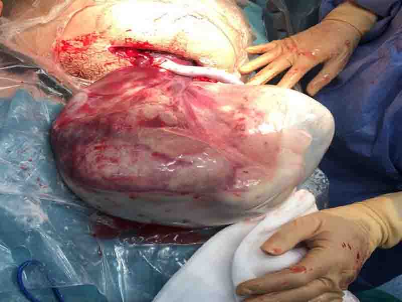 Veiled caesarean section: a baby is born in twin birth with the amniotic